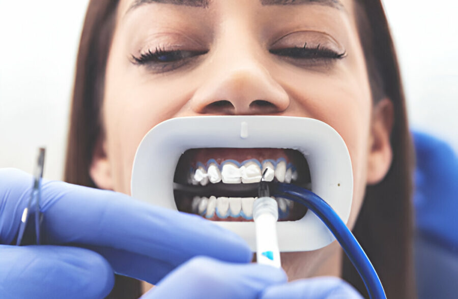 The Science Behind Teeth Whitening Gel: How It Works and Why It's Effective_2