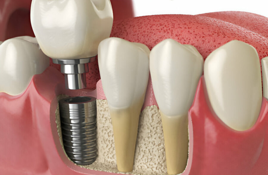 How to Care for Your Dental Implants: Tips for Long-lasting Results_1