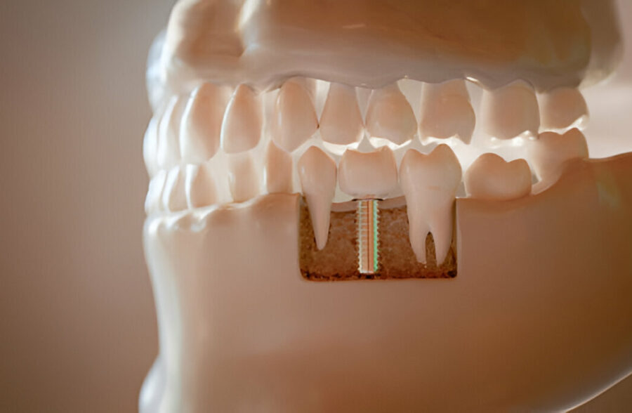 How to Care for Your Dental Implants: Tips for Long-lasting Results_FI