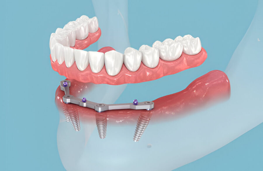 Immediate Dentures: The Quick Solution to Tooth Loss_1