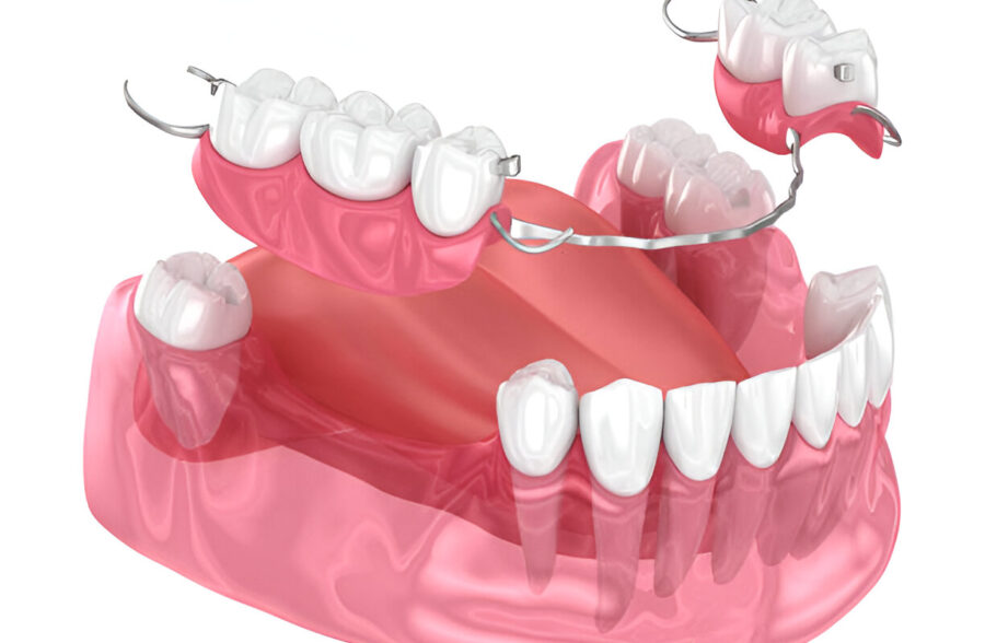 Immediate Dentures: The Quick Solution to Tooth Loss_2